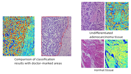Gastric Cancer Detection