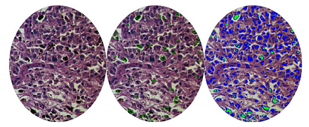 Skin Melanoma Recognition